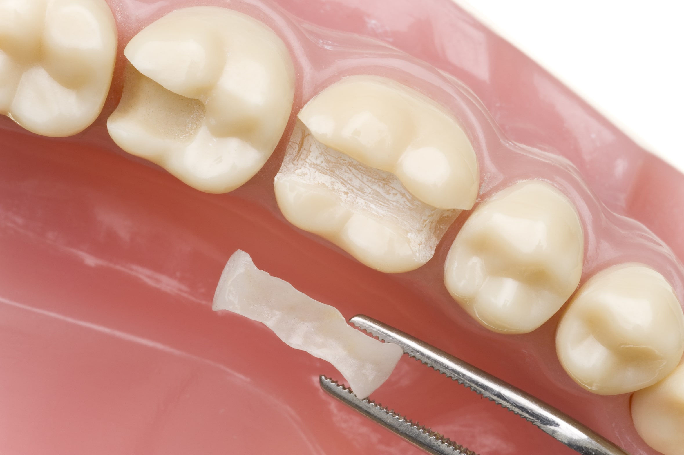 Zahnfüllungen: Informationen & Spezialisten für Zahnfüllungen